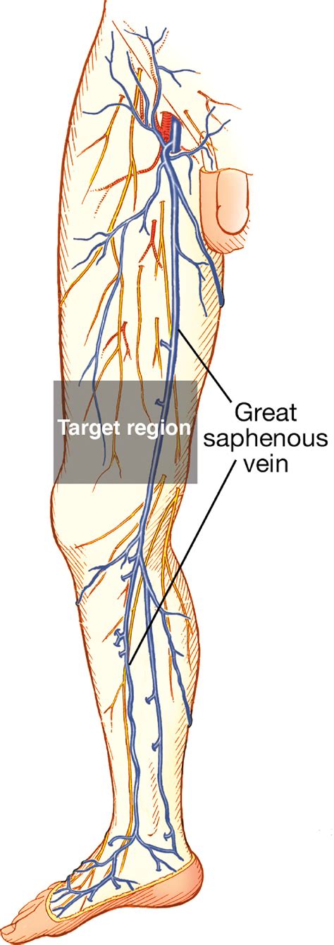 Graft consisting great saphenous vein